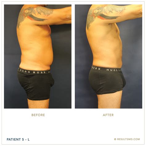 Male Liposuction Miami